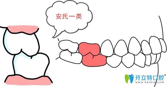 安氏一類的癥狀示意圖