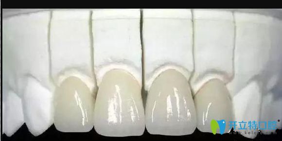 即使做了4顆烤瓷牙也有一定可能性可以做正畸