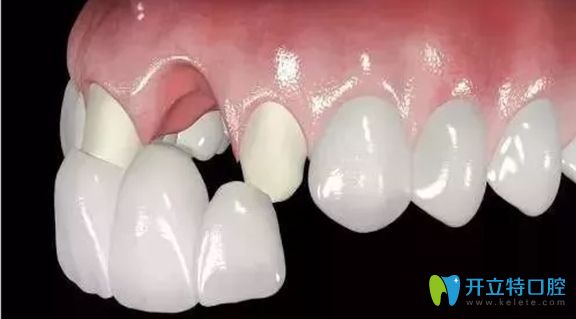 只有一兩顆烤瓷牙，還是可以考慮進(jìn)行牙齒矯正的