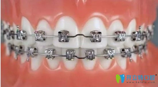 美國3m自鎖托槽矯正優(yōu)勢(shì)