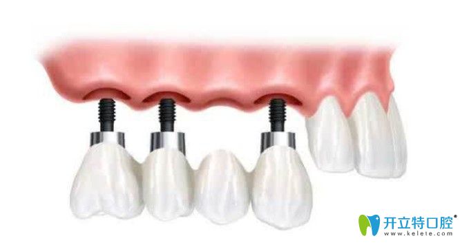 種植牙脫落是不能二次使用的