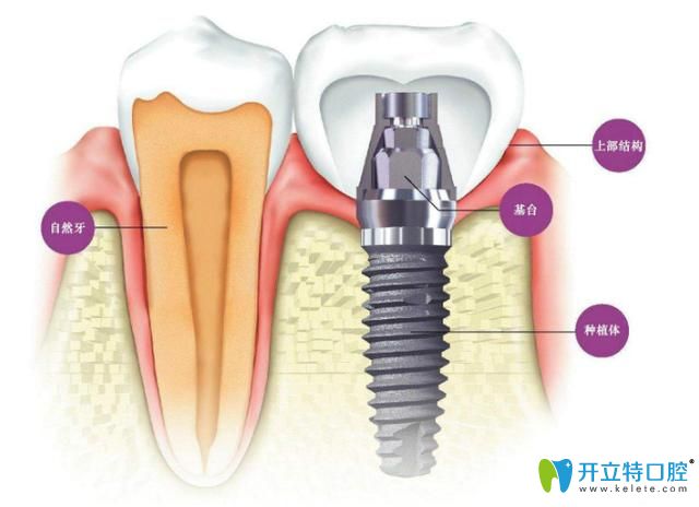 天津愛(ài)齒口腔周貴祥醫(yī)生分享即刻種植牙手術(shù)過(guò)程