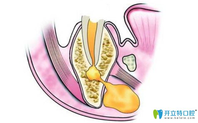 章瓏醫(yī)生告知牙髓壞死還需要根管治療嗎 章瓏醫(yī)生告知牙髓壞死還需要根管治療嗎