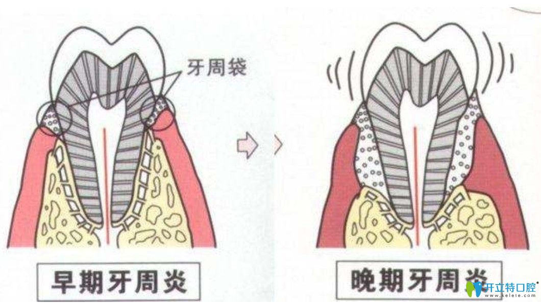 王維偉醫(yī)生科普牙周炎程度怎么區(qū)分 王維偉醫(yī)生科普牙周炎程度怎么區(qū)分