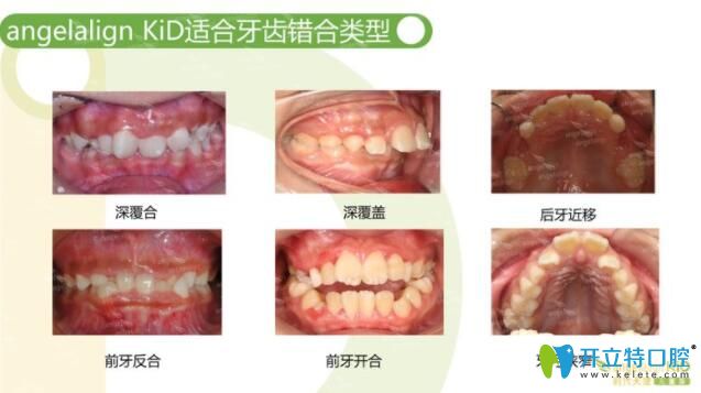 時(shí)代天使隱形矯正兒童版的適應(yīng)癥