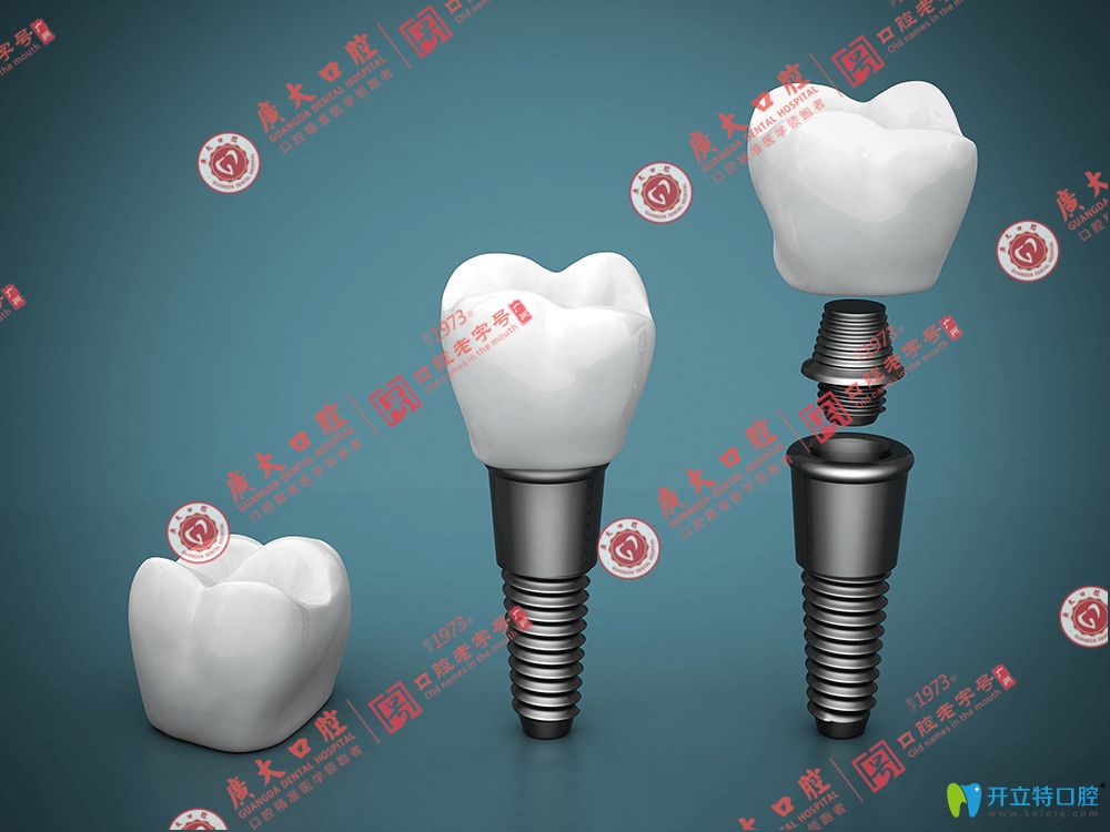 廣州廣大口腔瑞士ITI親水種植體