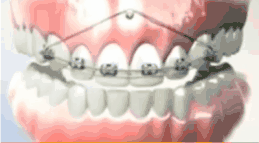 支抗釘低上前牙