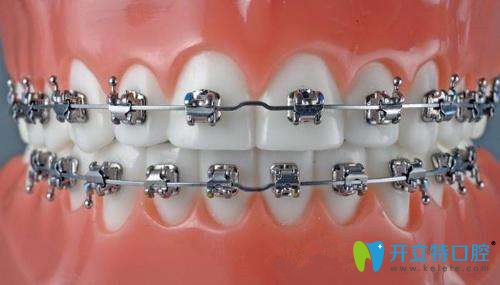 傳統(tǒng)方形自鎖托槽矯正器