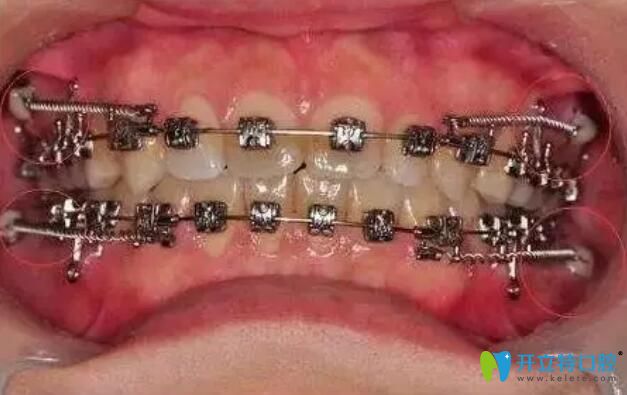 牙齒矯正支抗釘要打幾個