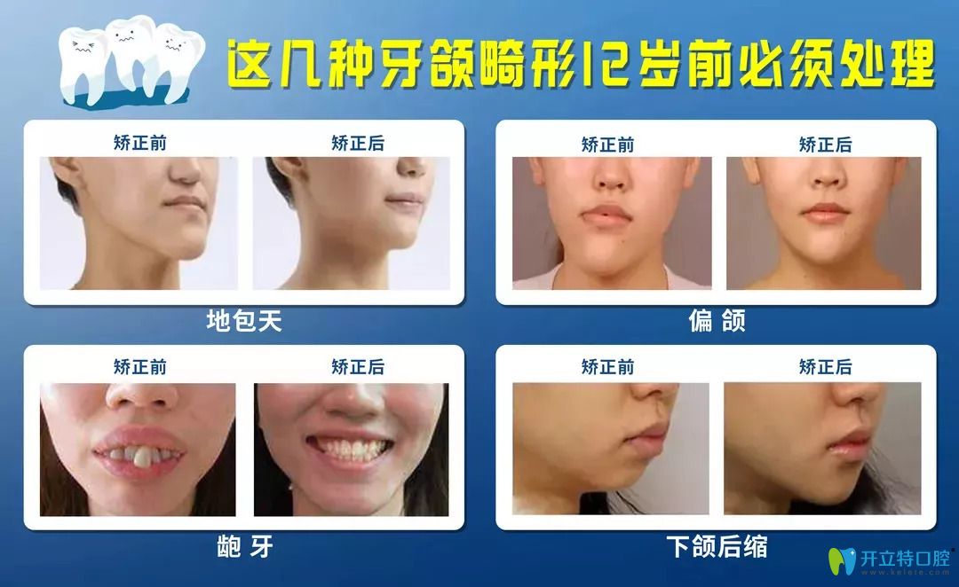 常見(jiàn)的牙頜畸形圖片