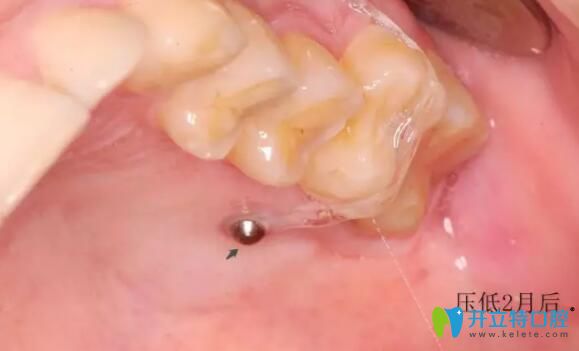 支抗釘壓低2個月后