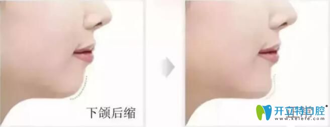 牙頜畸形之下頜后縮圖片