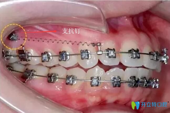 嘴凸正畸一定要打支抗釘嗎?有沒有副作用?矯牙前必看！