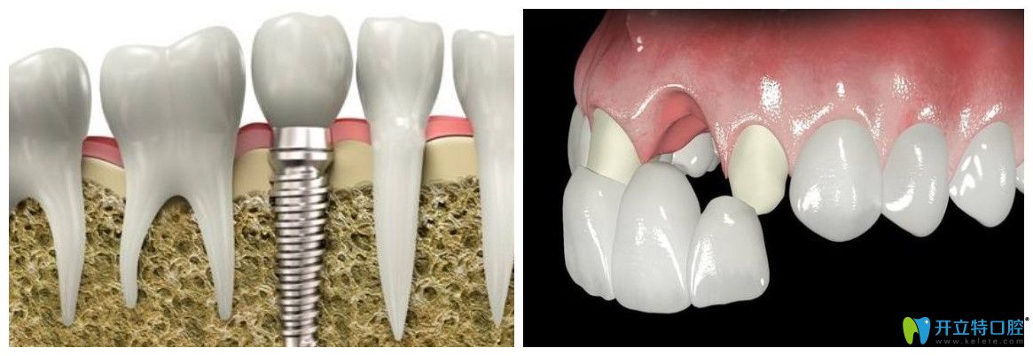 佳美口腔周蕾醫(yī)生建議年輕人做固定假牙