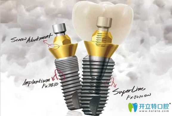 韓國登騰種植牙示意圖