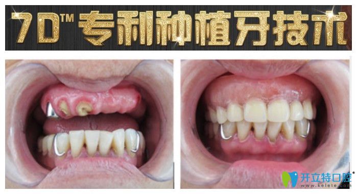 重慶團(tuán)圓口腔半口種植牙