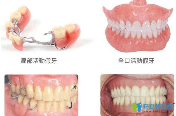 周蕾醫(yī)生告訴大家年輕人適合安活動(dòng)義齒嗎