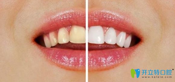 洛陽牙大夫口腔牙齒貼面價(jià)格很超值