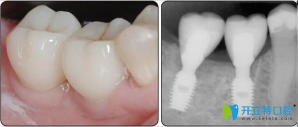韓國登特斯種植牙價格也較便宜