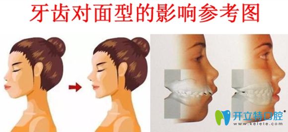 牙齒不齊對(duì)面型的影響圖