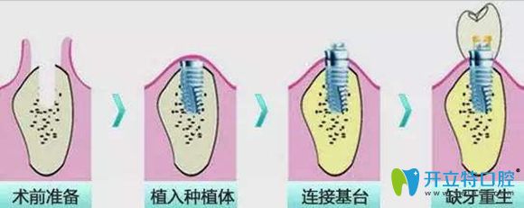 洛陽牙大夫口腔種植牙價(jià)格3999元一顆起
