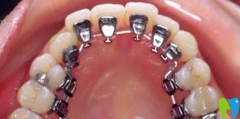 深圳珮斐齒科秦瑞玲介紹舌側(cè)隱形矯正技術(shù)優(yōu)勢(shì) 深圳珮斐齒科秦瑞玲介紹舌側(cè)隱形矯正技術(shù)優(yōu)勢(shì)