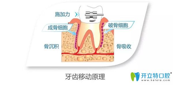 正畸加速器的牙齒移動(dòng)原理