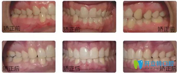 美速達(dá)正畸加速器效果前后對(duì)比