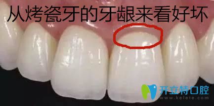 從烤瓷牙的牙齦來看好壞
