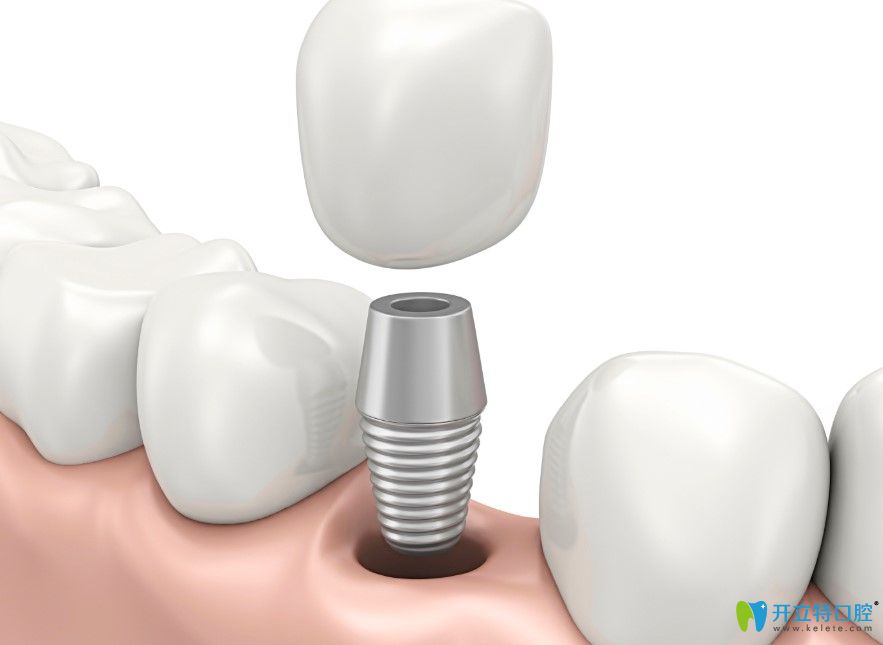 雷有朋醫(yī)生科普種植牙可以當(dāng)天完成嗎