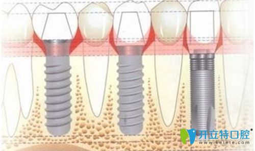 楊高醫(yī)生科普全口無牙頜種植固定修復(fù)