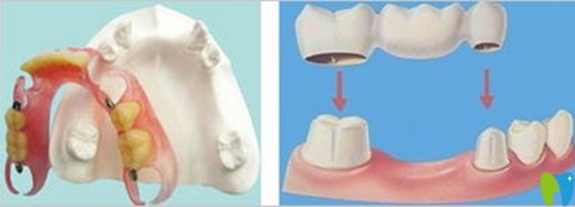 活動(dòng)義齒和固定義齒的區(qū)別圖 活動(dòng)義齒和固定義齒的區(qū)別圖