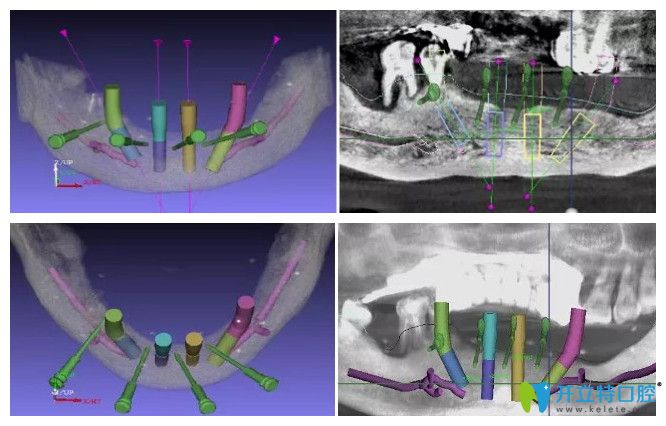 ALL—on—4半口種植牙5<span style=