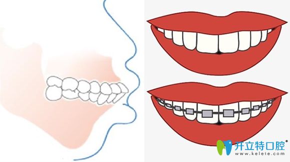 兒童牙齒矯形前后效果參考圖
