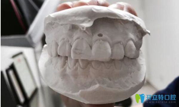 在北京美萊口腔牙齒咬膜