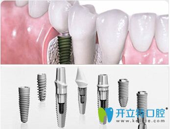 <!--<i data=20240703-sp></i>-->口腔<!--<i data=20240703-sp></i>-->醫(yī)生介紹前牙種植的優(yōu)勢 <!--<i data=20240703-sp></i>-->口腔<!--<i data=20240703-sp></i>-->醫(yī)生介紹前牙種植的優(yōu)勢