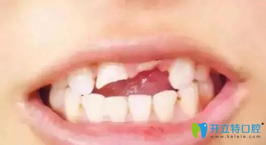 齒磕掉一塊不補(bǔ)可以嗎