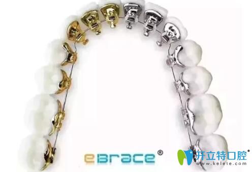 干貨:ebrace舌側矯正是自鎖的嗎,矯正痛嗎,附ebrace牙套價格