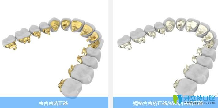 ebrace舌側(cè)牙套材質(zhì)