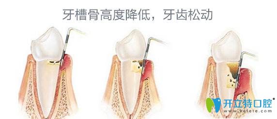 牙槽骨高度降低牙齒會(huì)松動(dòng)