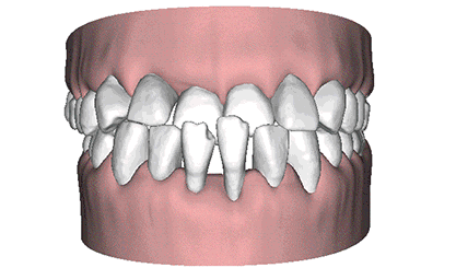 前牙深覆蓋動(dòng)畫(huà)圖解