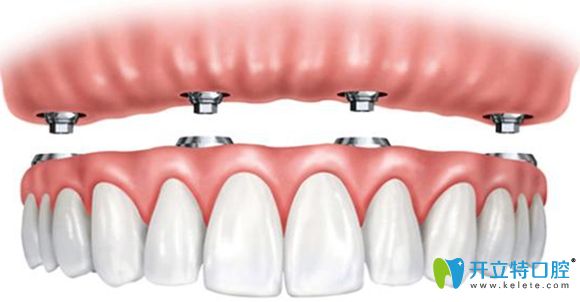半口固定種植牙修復(fù)示意圖