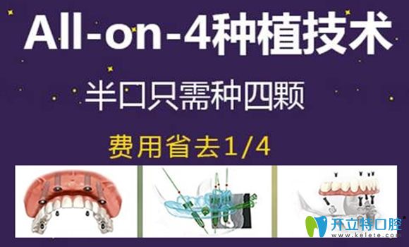 allon4種植牙技術宣傳圖
