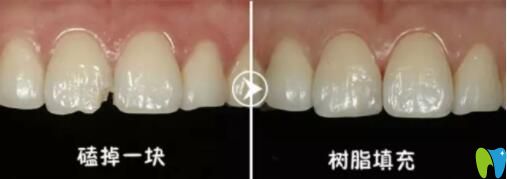 樹脂填充補(bǔ)牙