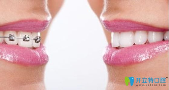 mbt直絲弓矯正效果