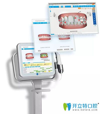 iTero口腔掃描儀