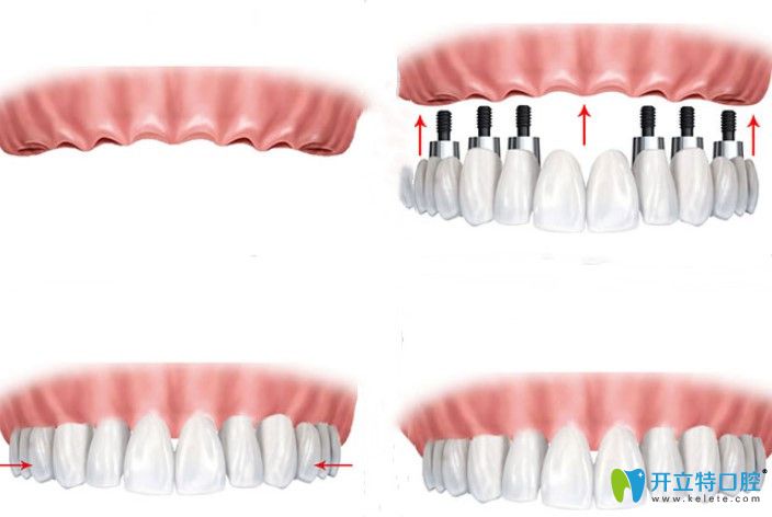 張奎醫(yī)生為您解答全口牙齒缺失能做種植牙嗎 張奎醫(yī)生為您解答全口牙齒缺失能做種植牙嗎