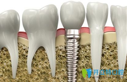 種植牙修復(fù)游離端牙的效果