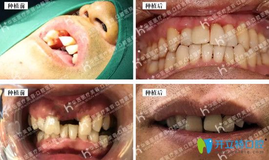 華醫(yī)口腔數(shù)字化種植牙案例展示