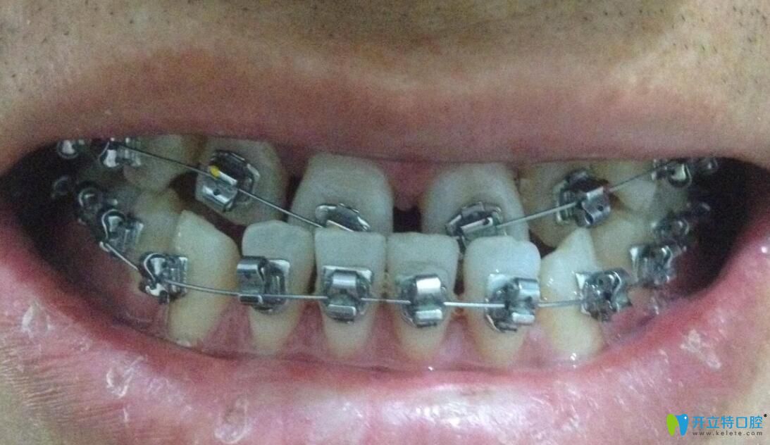 金屬固定矯正器矯正牙齒地包天